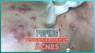 Big Cystic Acne Blackheads Extraction Blackheads & Milia Whiteheads Removal Pimple Popping