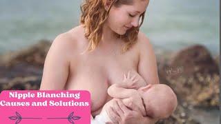 Nipple Blanching  Causes and Solutions for Breastfeeding Moms