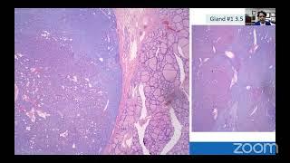 WHO 2022 Update on Parathyroid tumors by Ashraf Khan USA