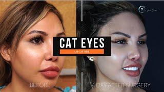 CAT EYES SURGERY + LIP LIFTING OPERATION OP. DR. YUCEL SARIALTIN