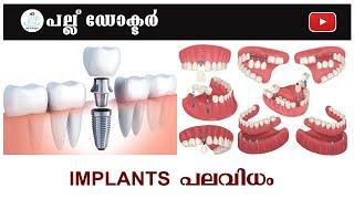 Implants പലവിധം  Exploring the Diversity of Dental Implants Types Advantages and Considerations