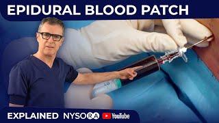EPIDURAL BLOOD PATCH