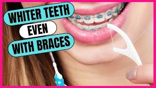 Best Methods For Keeping Teeth White With Braces