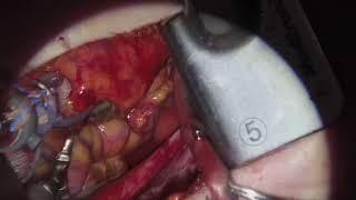 Asvide The video shows a clinical case as an example of beating heart multi-vessel minimally...