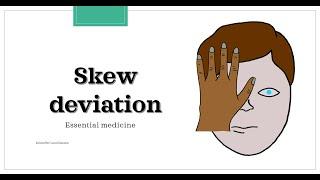 Skew deviation test  Test of Skew Essential medicine