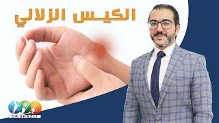 الكيس الزلالي  دكتور أحمد الشاذلي - إستشاري جراحة العظام