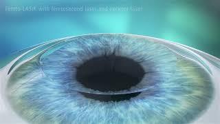 Femto-LASIK Treatment Animation