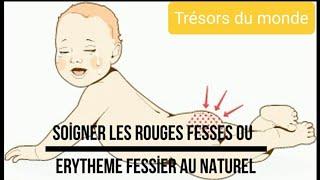 COMMENT SOIGNER LES FESSES ROUGES DU BEBE AU NATUREL.  HOW TO CARE  BABYS RED BUTTOCKS NATURALLY