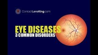 Eye Diseases  3 Common Eye Conditions