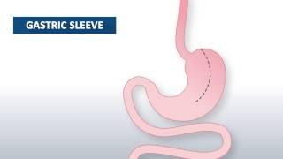 What is gastric sleeve surgery?  Beaumont Health