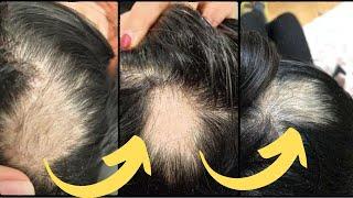 For Stronger Thicker Longer Hair – Natural Hair Growth Thickening Treatment   Stop Thinning