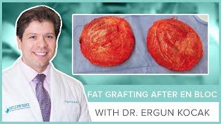 Fat Transfer Breast Augmentation After En Bloc Capsulectomy by Dr. Ergun Kocak