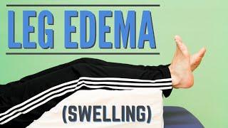 Top 7 Exercises for Leg Edema or Swelling Program or Protocol for Edema