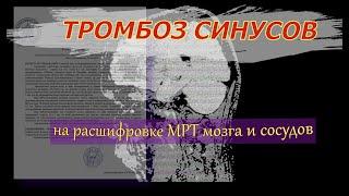 ТРОМБОЗ синуса на РАСШИФРОВКЕ МРТ головного мозга и сосудов. Гипоплазия позвоночной артерии.