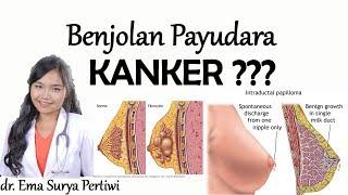 6 Jenis Benjolan Kanker Payudara dan Non Kanker  dr. Ema Surya P