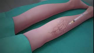 Sclerotherapy Procedure