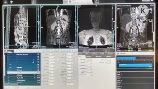 MRI DL SPINE WITH WSS FULL PLANNING AND FILMING UNITED IMAGING MRI MACHINE