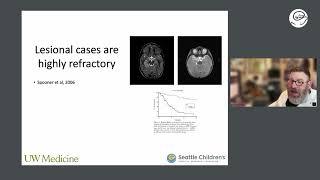 Epilepsy Surgery in Children