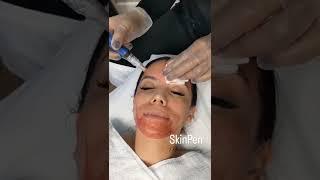 Microneedling SkinPen Phoenix AZ Medspa Body By Leverett