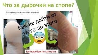 Белые точки на стопе дырочки на пятках.  Мелкоточечный кератолиз Рitted keratolysis