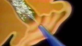 Murine Ear Wax Removal System commercial - 1992