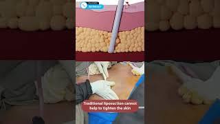 Difference Between Traditional and Vaser Liposuction  Divine Cosmetic Surgery #shorts