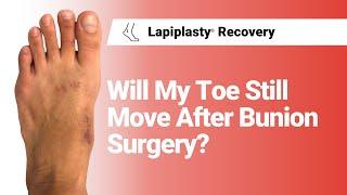 Will My Toe Still Move After Bunion Surgery?  Lapiplasty® Recovery
