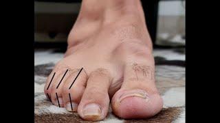 Surgical Correction of Mallet Toes