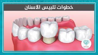شرح مراحل تلبيس الاسنان في علاجك الطبية