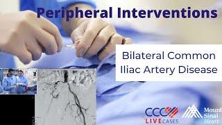 Bilateral Common Iliac Artery Disease - November 2017