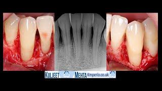 Periodontal surgery lower teeth with GTR. Emdogain and OsteoBiol.