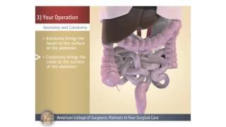 ColostomyIleostomy Your Operation