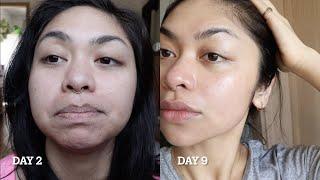 MY SKIN AFTER 9 DAYS OF TRETINOIN  BEFORE AND AFTER RESULTS