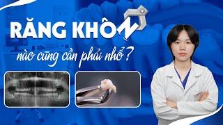 Răng Khôn Nào Cũng Phải Nhổ ?  Nam Bùi Vinalign