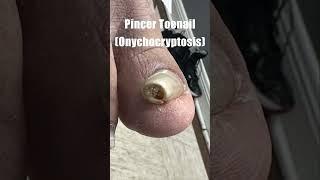 Pincer Toenail Onychocryptosis