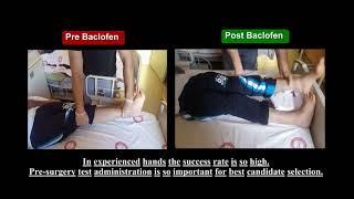 Intrathecal Baclofen Pump Surgery is so effective on Spasticity treatment