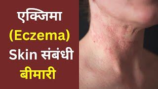 Eczema क्या हैं  Eczema की पूरी जानकारी  eczema kya hota hai  eczema ka ilaj