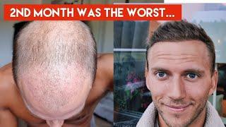 My Hair Transplant Journey - The AWFUL first 4 months in-depth walkthrough week by week