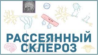 Рассеянный склероз - причины симптомы диагностика лечение