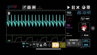 SVT with alarm sounds