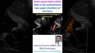 Atrial septal defect ASD Hole in the wall between two upper chambers of the heart