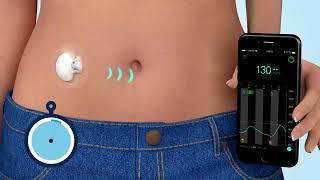 What is Continuous Glucose Monitoring CGM