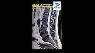 Disc herniation #Discmigration  #Discextrusion #UmamaheswaraReddy.V.