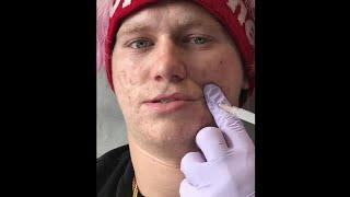 Supreme Patty Taking Needles To The Face For The First Time Acne Treatment