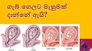 ගැබ් ගෙලට මැහුමක් දාන්නේ ඇයි? Cervical cerclage