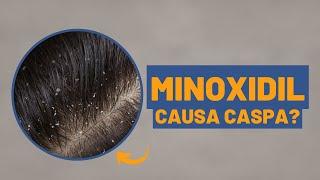 Minoxidil causa caspa?  Dra. Débora Cadore  Dermatologista Florianópolis