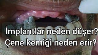 Diş implantları neden düşer? Uzun dönem İmplant etrafındaki kemik neden erir ?