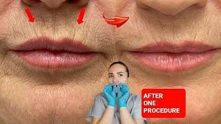 Quick massage for LIP LINES  Wrinkles around the lips