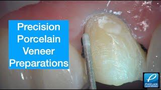 Precision Porcelain Veneer Preparation with a Zeiss ProErgo microscope.