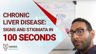 Chronic Liver Disease Signs and Stigmata in 100 seconds